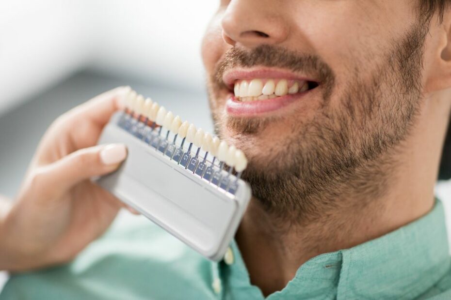 Faccette Dentali