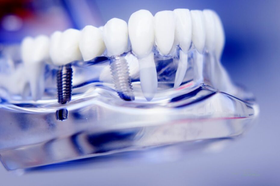 Implantologia dentale a Roma