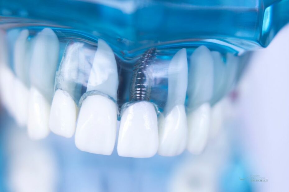 implantologia dentale soluzioni moderne